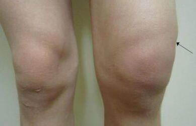 Clinical Events Arthrosis Knee Wrench
