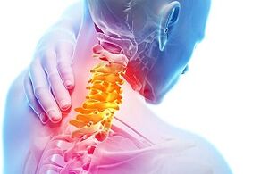 Symptoms of cervical osteochondrosis and food rules for disease