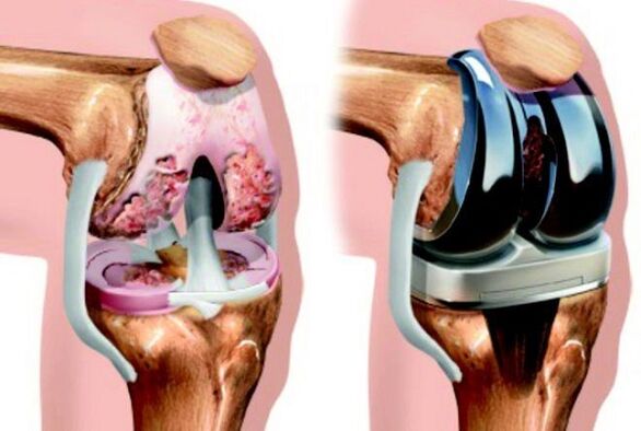 Before and after endoprotetics of wrist knee with arthrosis