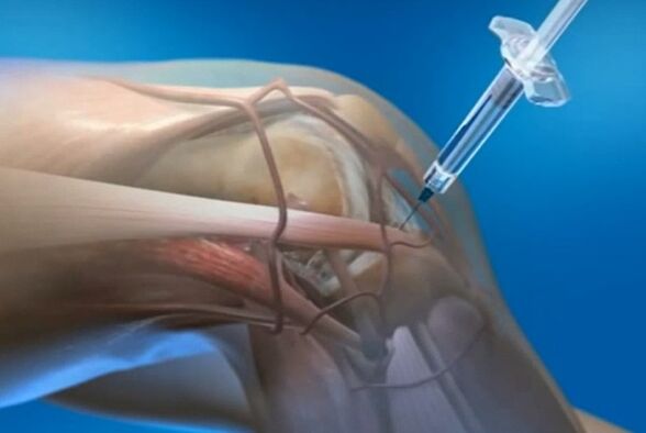 Intra -Articular injections for knee joint arthritis