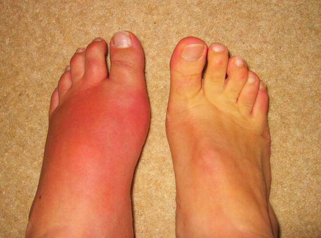 pain in the joints of the legs due to gout